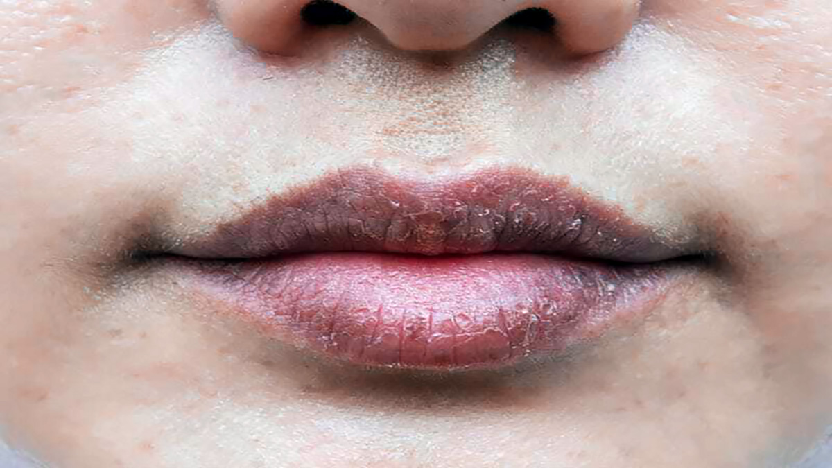 Home remedies for chapped lips - Fashion & Fitness